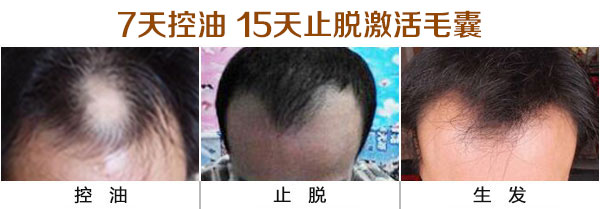 脱发.jpg